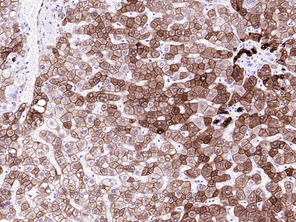 CK-Pan Clone BS5 IHC on Liver Tissue