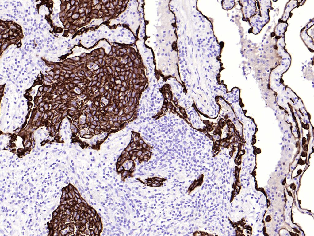 CK-pan clone BS5 IHC, squamous lung cell carcinoma